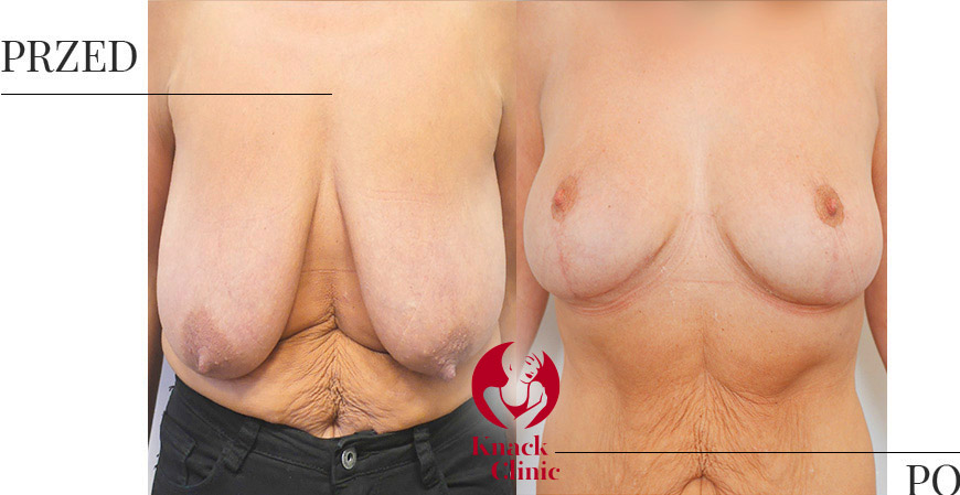 Pomniejszenie piersi – przed i po zabiegu