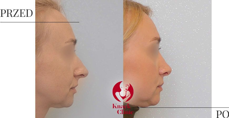 Operacje plastyczne nosa – efekty przed i po zabiegach