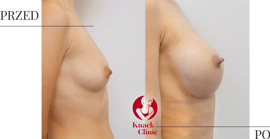 Podnoszenie piersi – przed i po